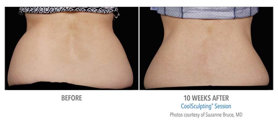 Before and After Coolsculpting Results - Sheer Sculpt