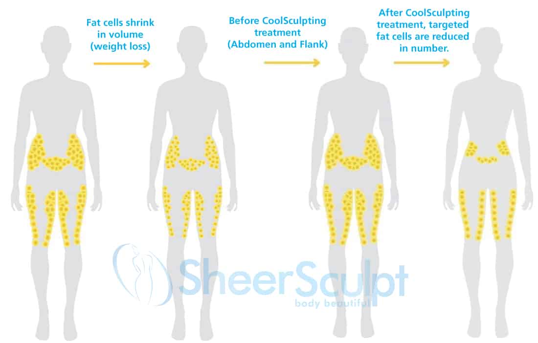Before and after coolsculpting fat cells are reduced
