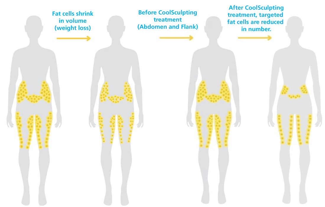 CoolSculpting-Targeted-Reduction-of-Fat-Cells