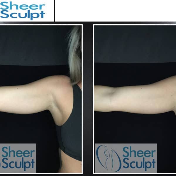 Before And After Coolsculpting Results Sheer Sculpt Coolsculpting In Philadelphia 