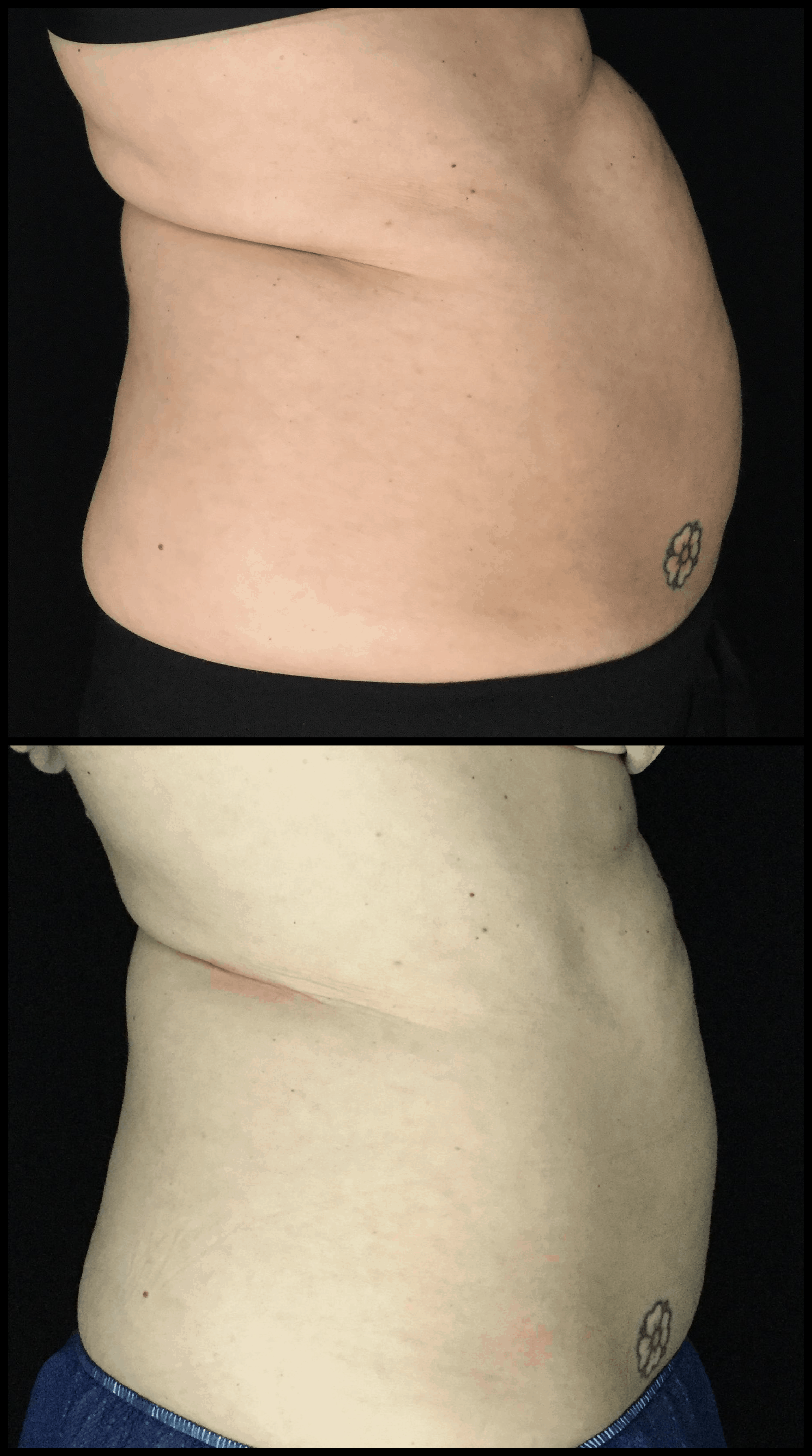 Before and After Coolsculpting Results - Sheer Sculpt